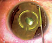 Keraring Lens - Cirurgia
