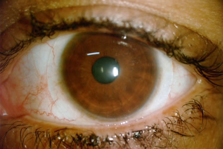 Lentes gelatinosas Optimun XC